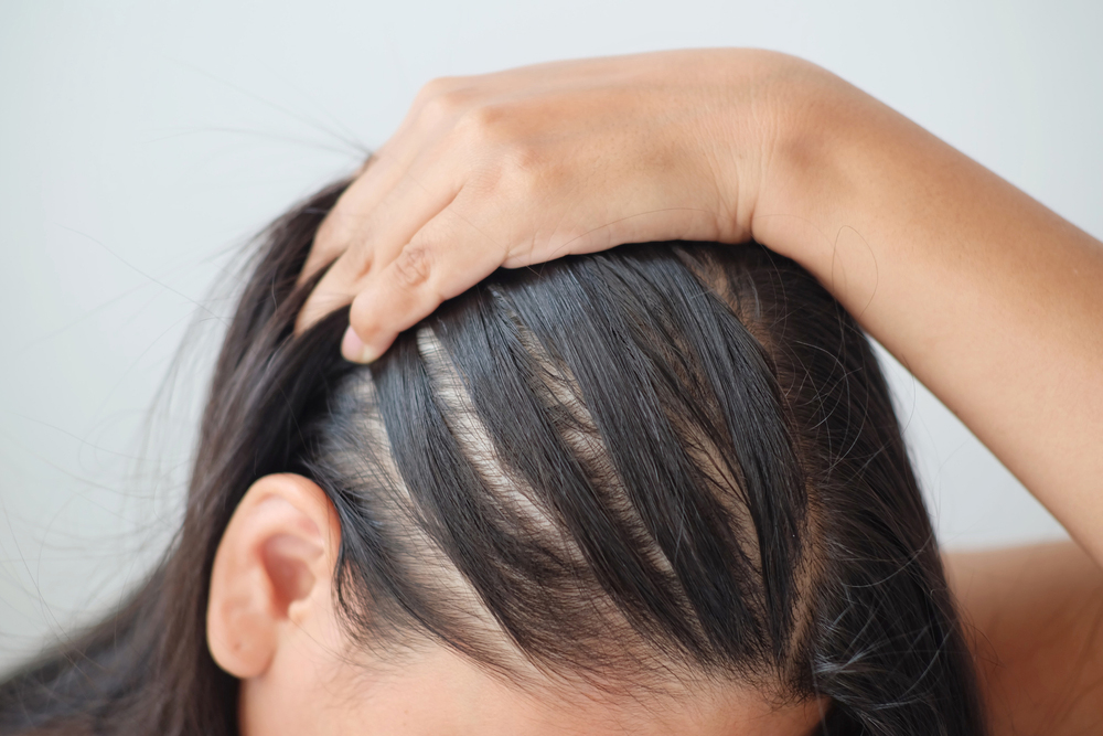 hair loss from stress